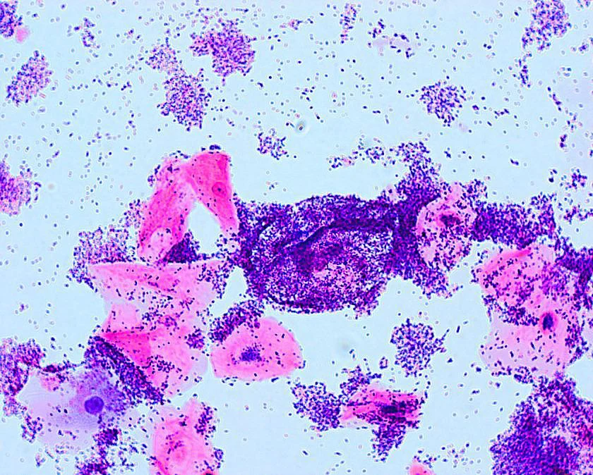 Vaginitis or Cervicitis? The Vaginal Culture Gives the Answer