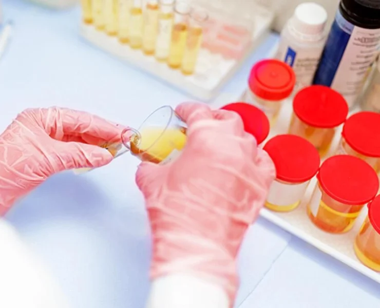 Γενική ούρων αποτελέσματα και ερμηνεία