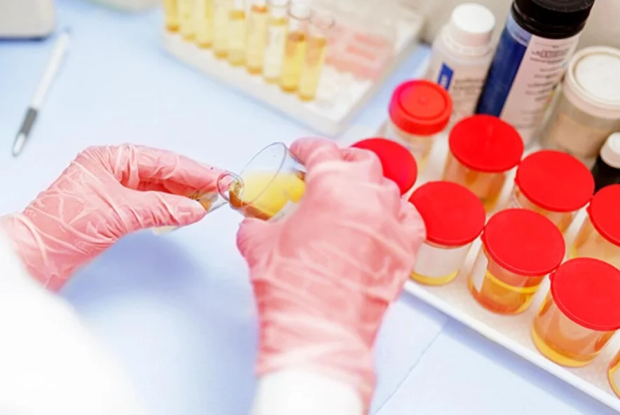 Γενική ούρων αποτελέσματα και ερμηνεία