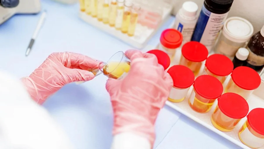 Urinalysis Results: A Simple Guide for Everyone