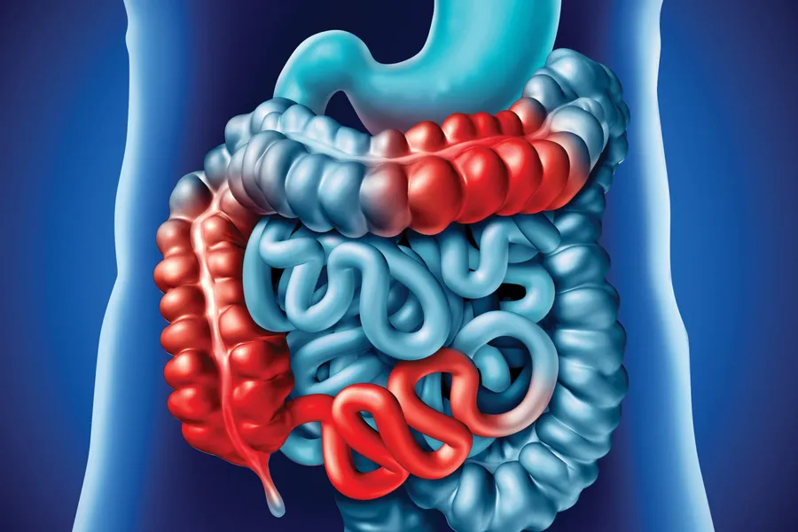 Coeliac Disease